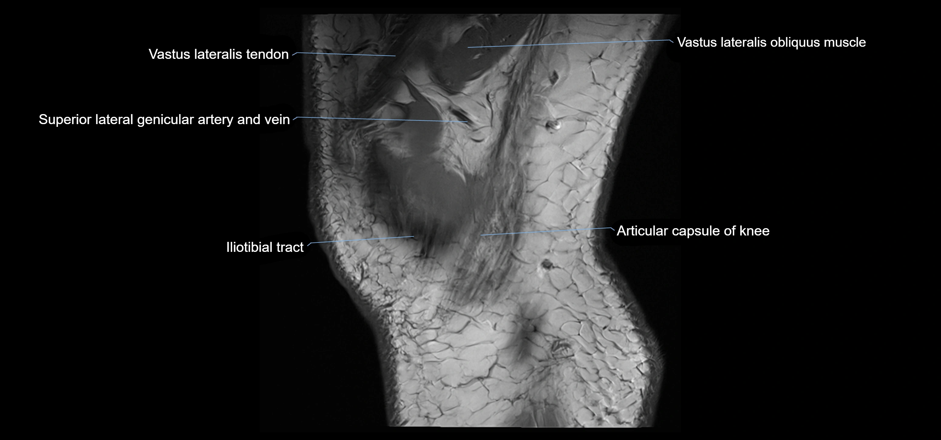 MRI knee sagittal cross sectional anatomy labelled 3T radiology image-00043.webp